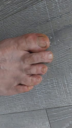 Customer photo review of Pentachom Antifungal Laser Program