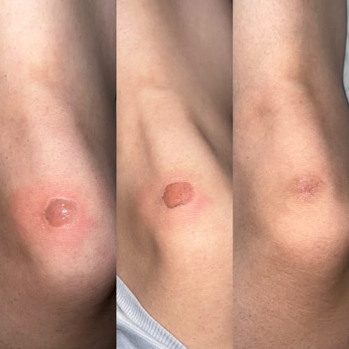 Customer photo review of Scar Gel