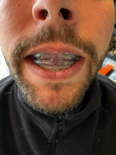Fotorecensie van een klant over Anti Snurkbeugel