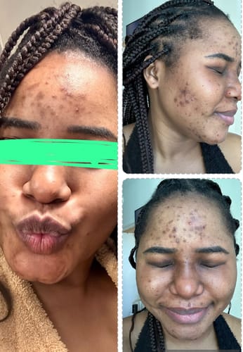 Customer photo review of Anti-Acne Beauty Bar for Oily Skin