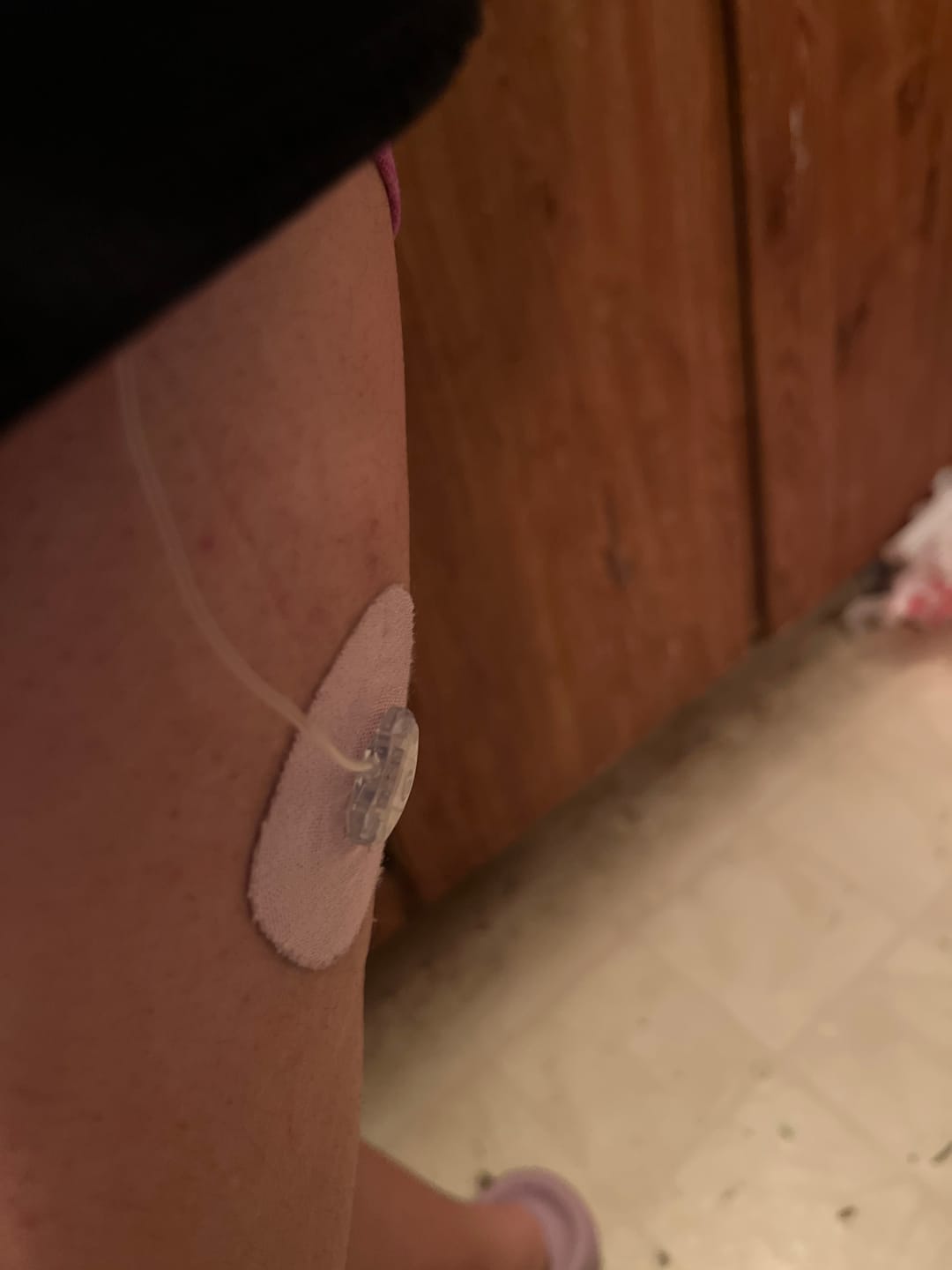 Customer photo review of Skin Grip Original - Universal Adhesive Patches (0.8 inch Hole)