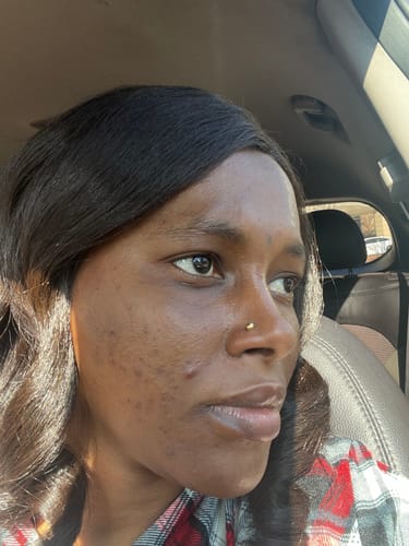 Customer photo review of Dark spot serum