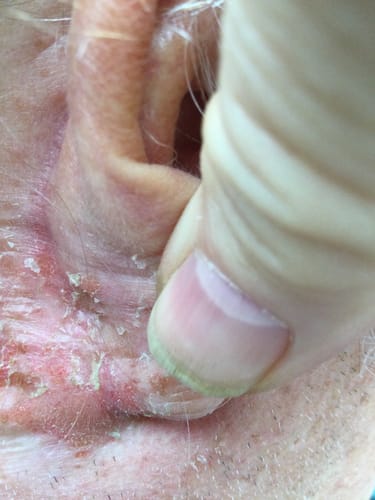 Customer photo review of Macs Tetracycline Skin Ointment 3%, 12gm (2 & 3 Pack)