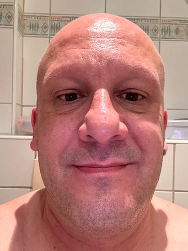 Customer photo review of Hyaluronserum | Hyaluronic Serum