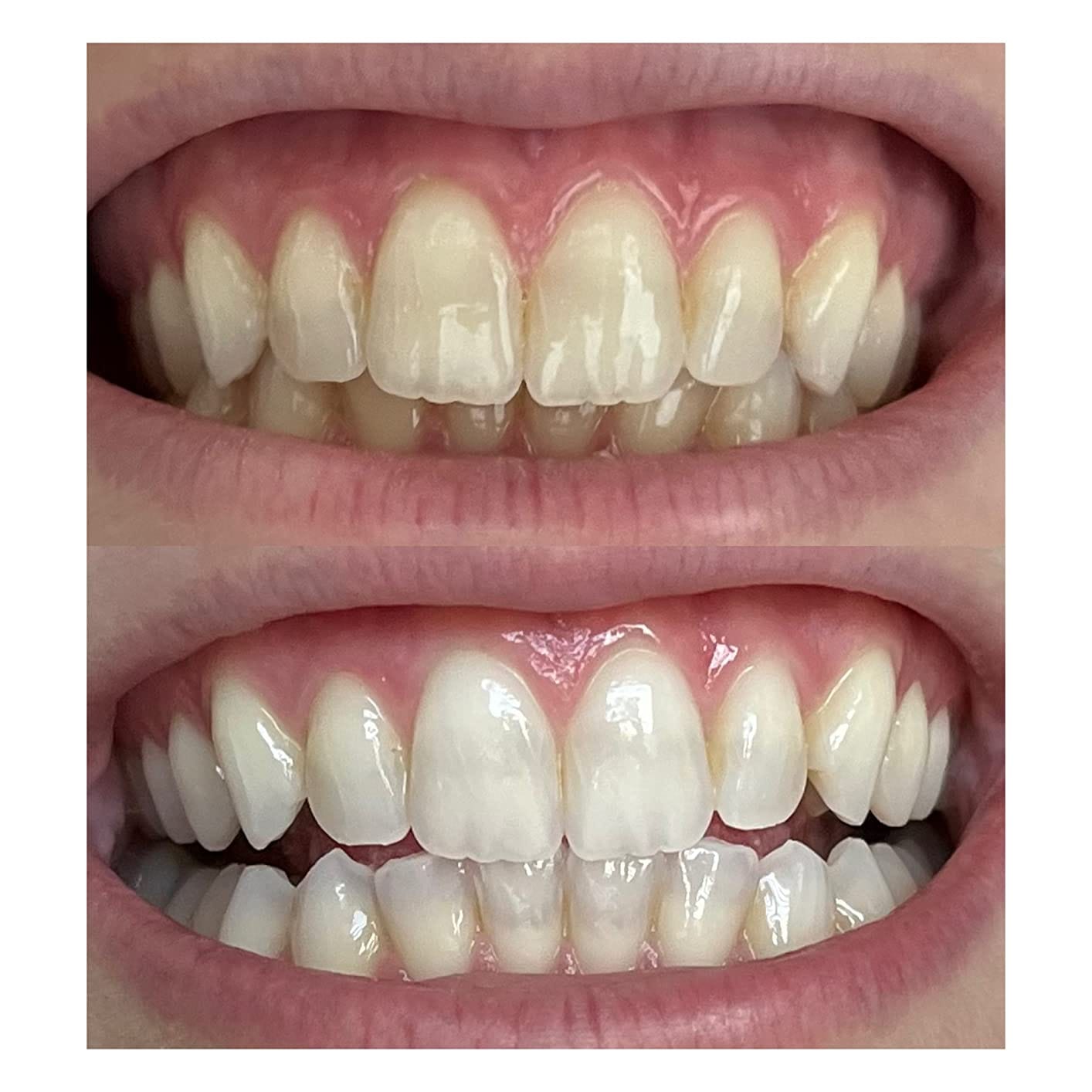 Customer photo review of LYSS 405nm sada na bielenie zubov