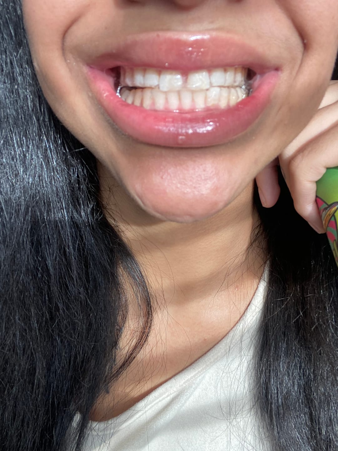 Customer photo review of Teeth Whitening Strips