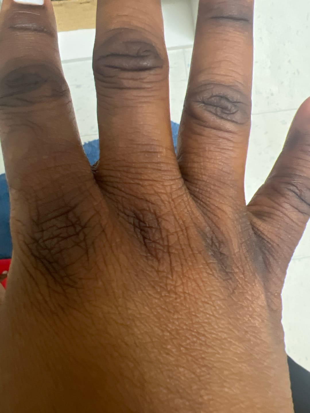 Customer photo review of Extreme Dark Hands Feet Knees And Elbows Repair Cream