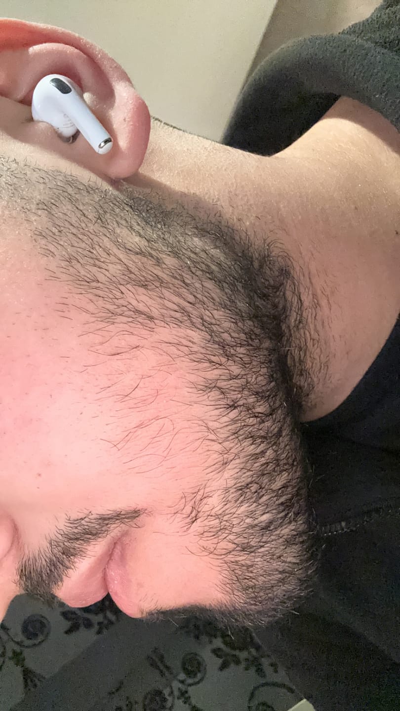 Customer photo review of VITAFOAM ™ & Scalp Roller Hair Growth Kit