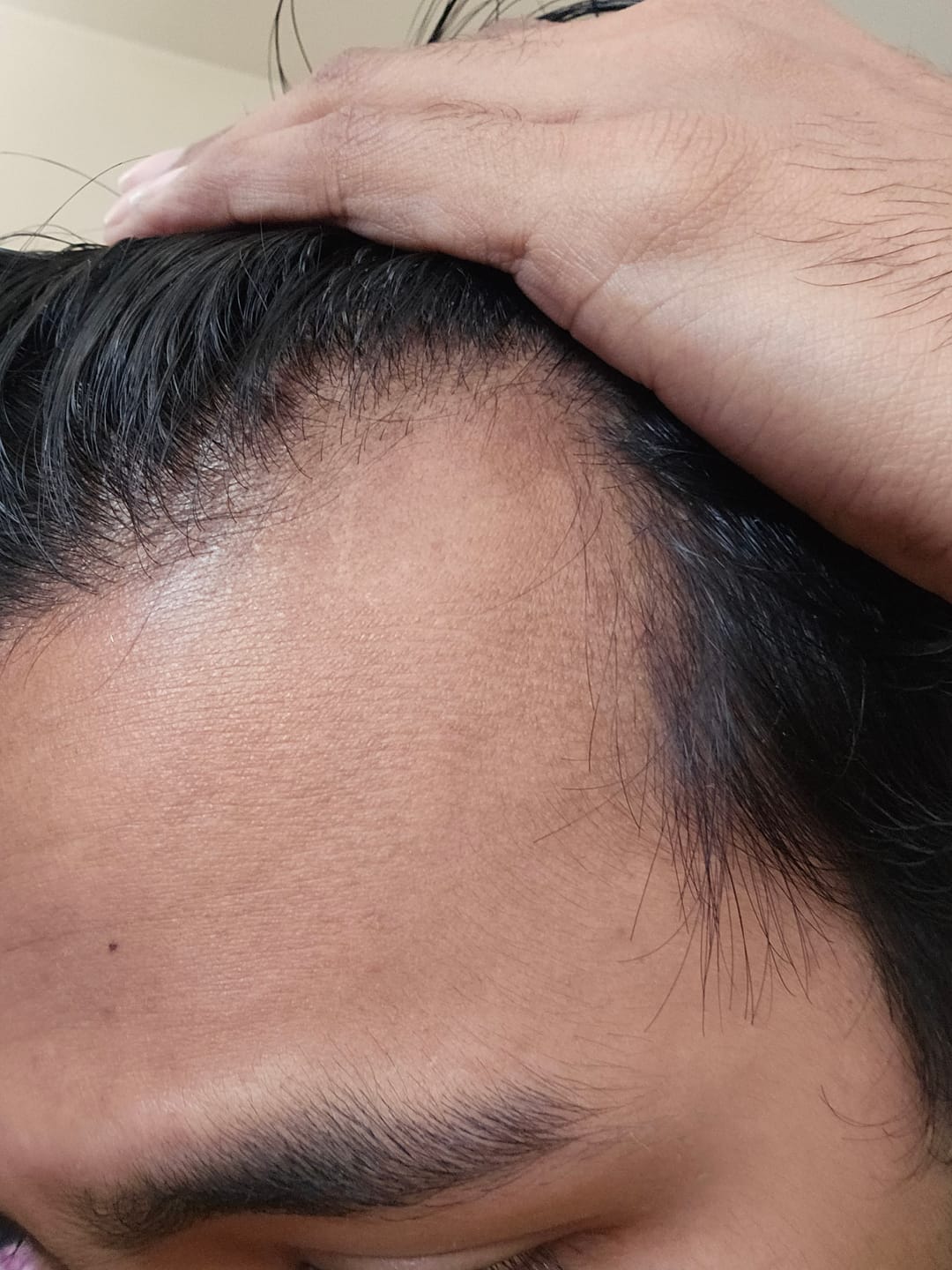 Customer photo review of VITAFOAM ™ & Scalp Roller Hair Growth Kit