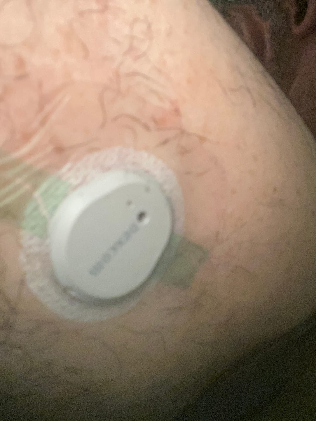 Customer photo review of Skin Grip Original - Dexcom G7 Adhesive Patches (With Cutout)