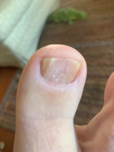 Customer photo review of Onychom - Antifungal Laser Device