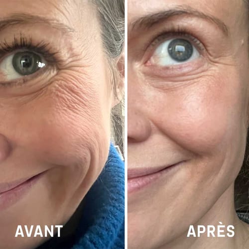 Customer photo review of Masque Coréen au Collagène Invisible (Joues et front)