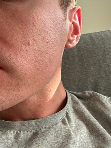 Customer photo review of Starter Acne Program™