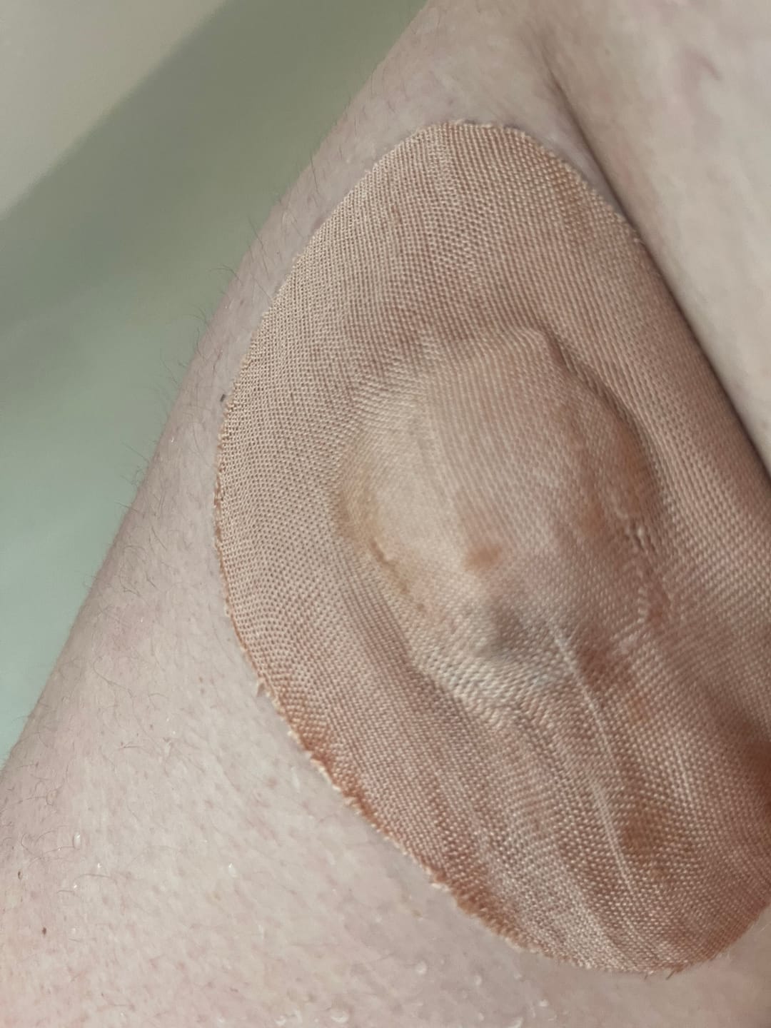 Customer photo review of Skin Grip Original - Medtronic Guardian/Enlite Adhesive Patches
