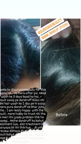 Customer photo review of Anti-dandruff Hair Oil With Rosemary & Olive Oil Extract for Scalp - Defence Hair Oil - Single