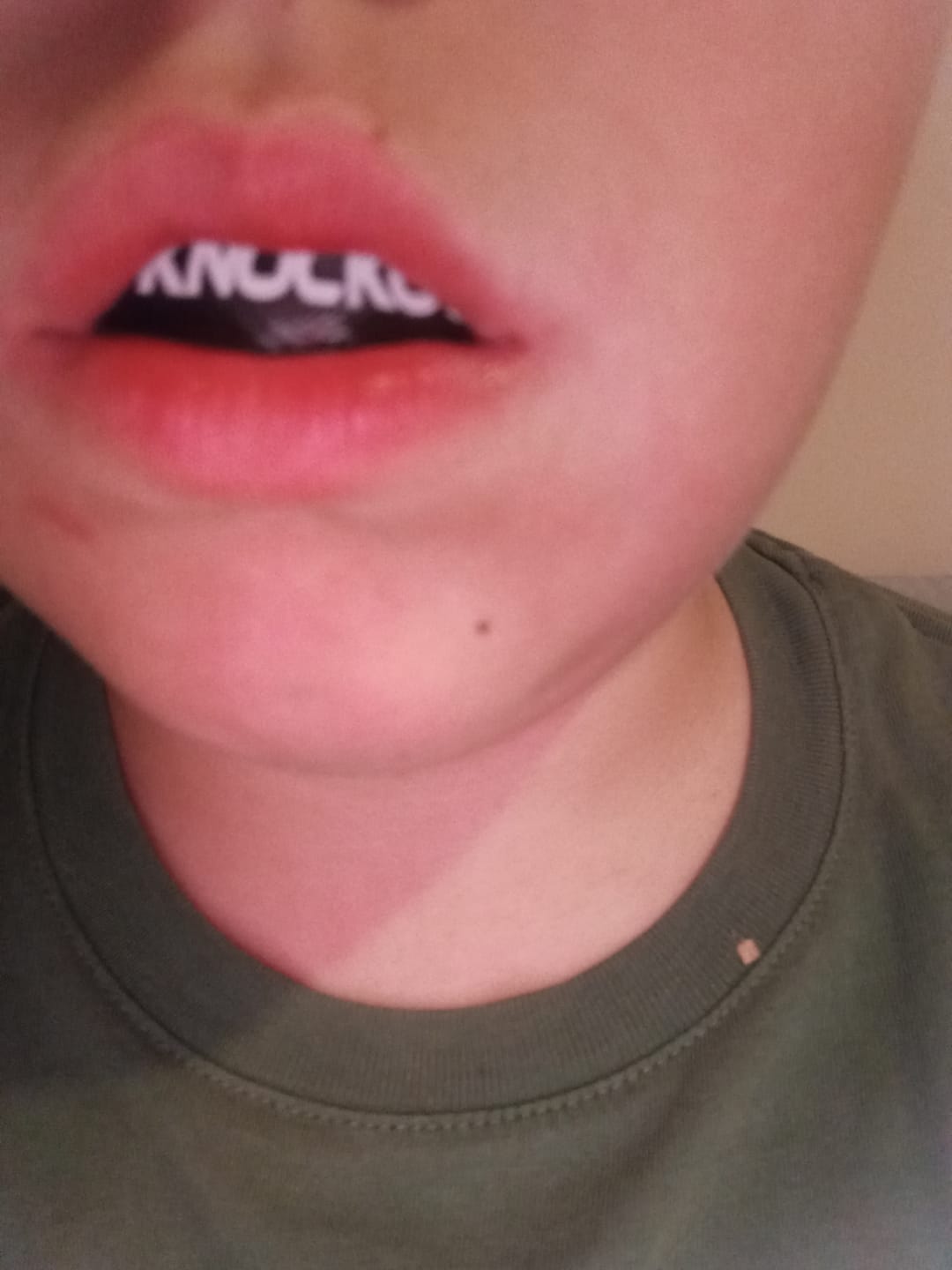 Customer photo review of Proteza Dentara  Knockout GEL