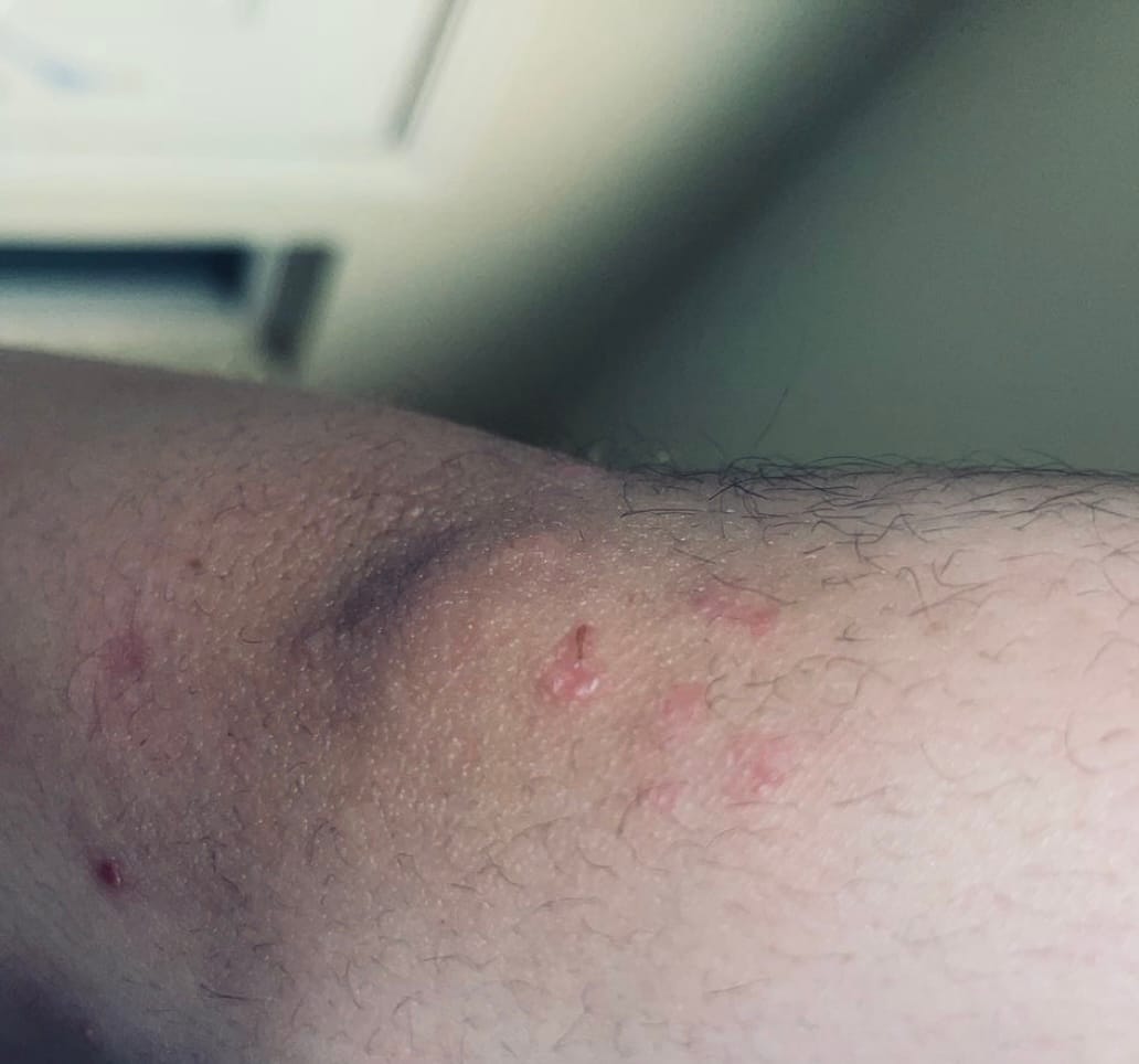 Customer photo review of Psoriasis Honey Nourishing Scalp and Skin Serum