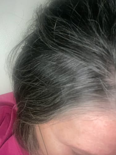 Customer photo review of ערכה הוליסטית לטיפול בקשקשים | Scalp Control