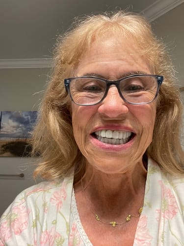Customer photo review of Upper and Lower Retainers Set
