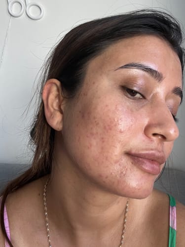 Customer photo review of Intermediate Acne Program™