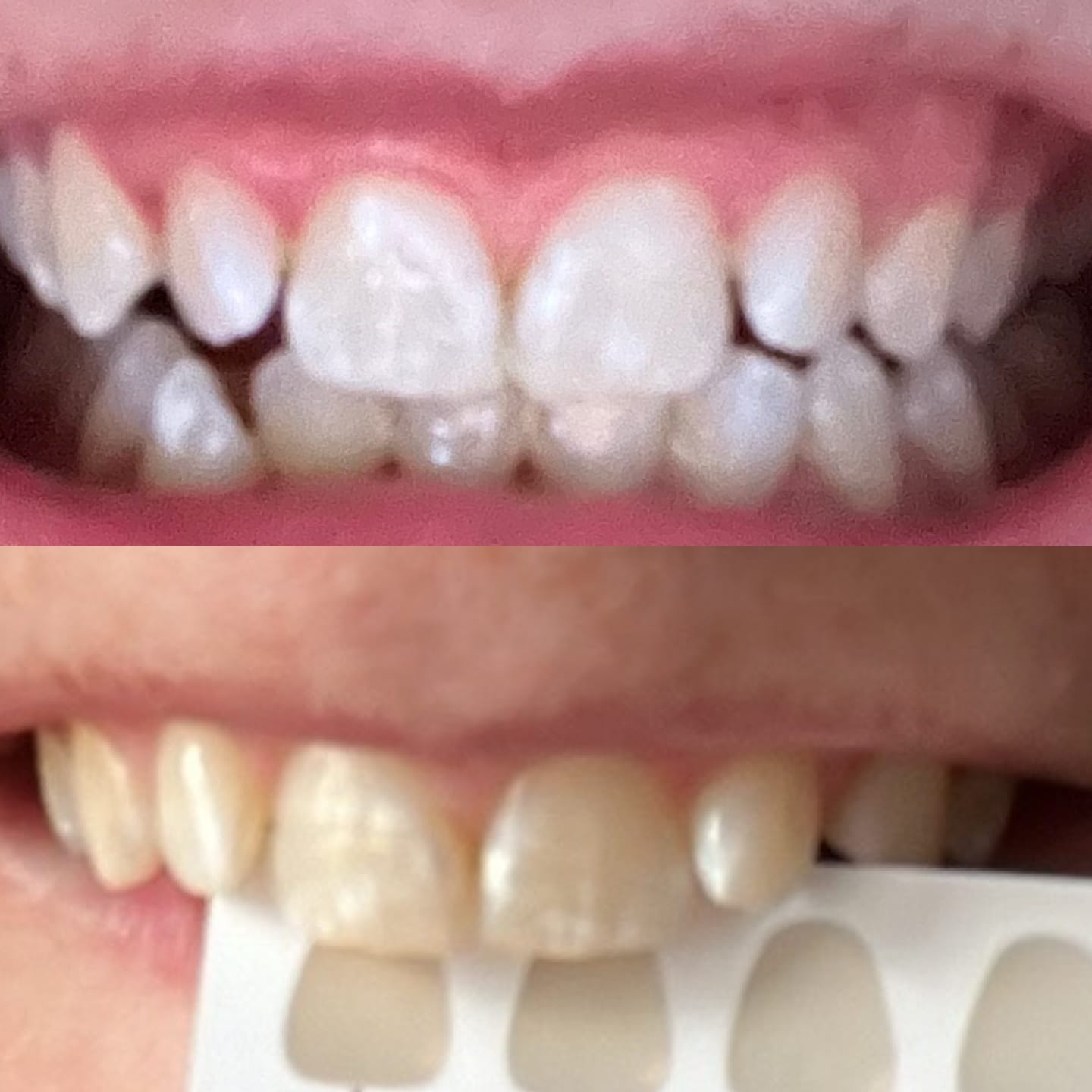 Customer photo review of Teeth Whitening Strips
