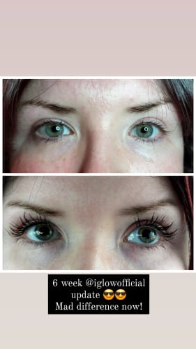 Customer photo review of 2x iGlow Lash Maximizer – Lash Serum, 3 ml