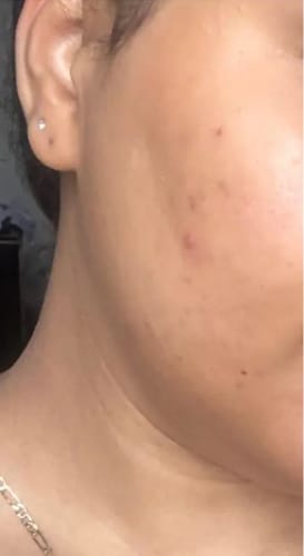 Customer photo review of VitaBeam Skin Revive | Lichttherapie