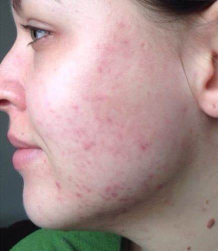 Customer photo review of VitaBeam Skin Revive | Lichttherapie