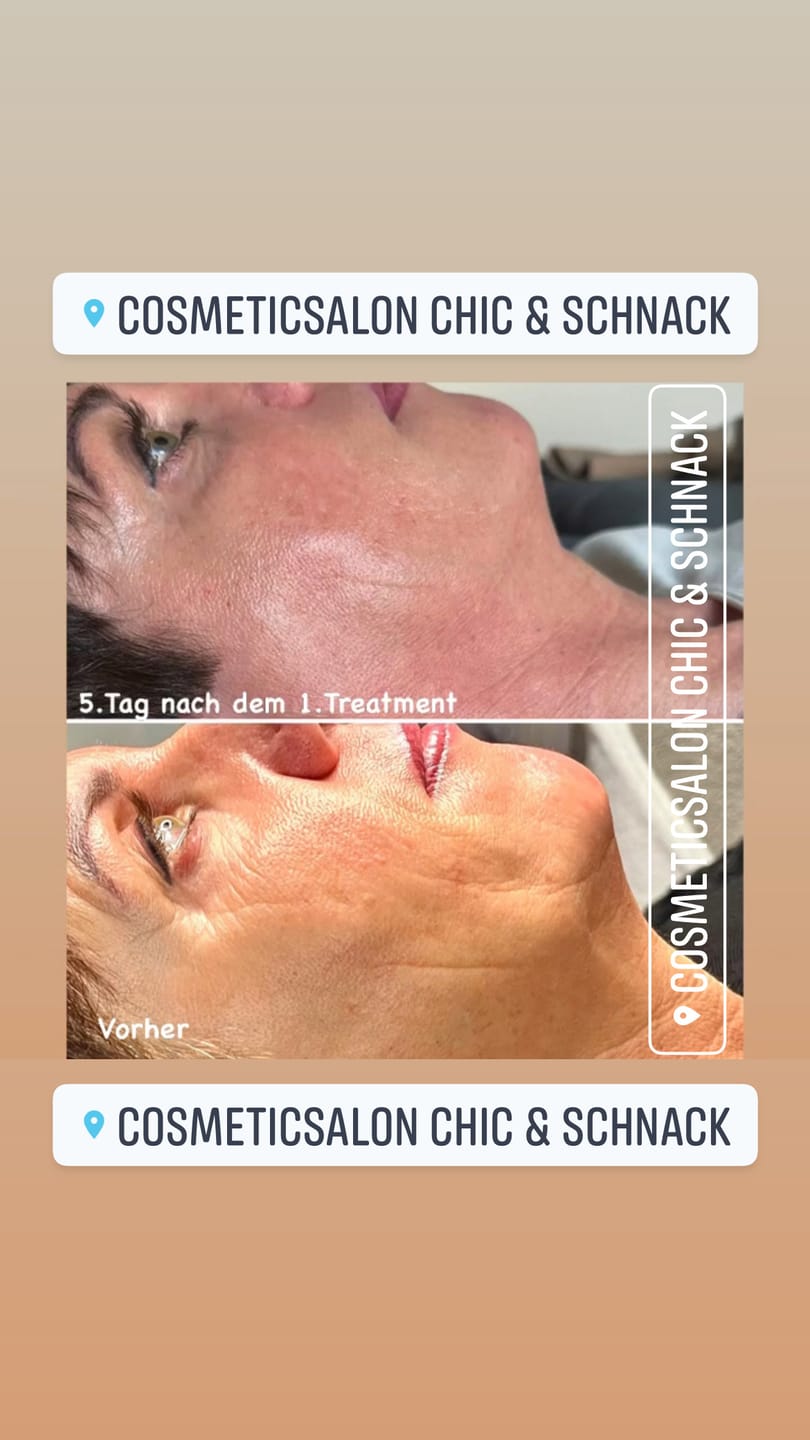 Customer photo review of SQT Biomicroneedling großes Starterset inkl. Online Schulung