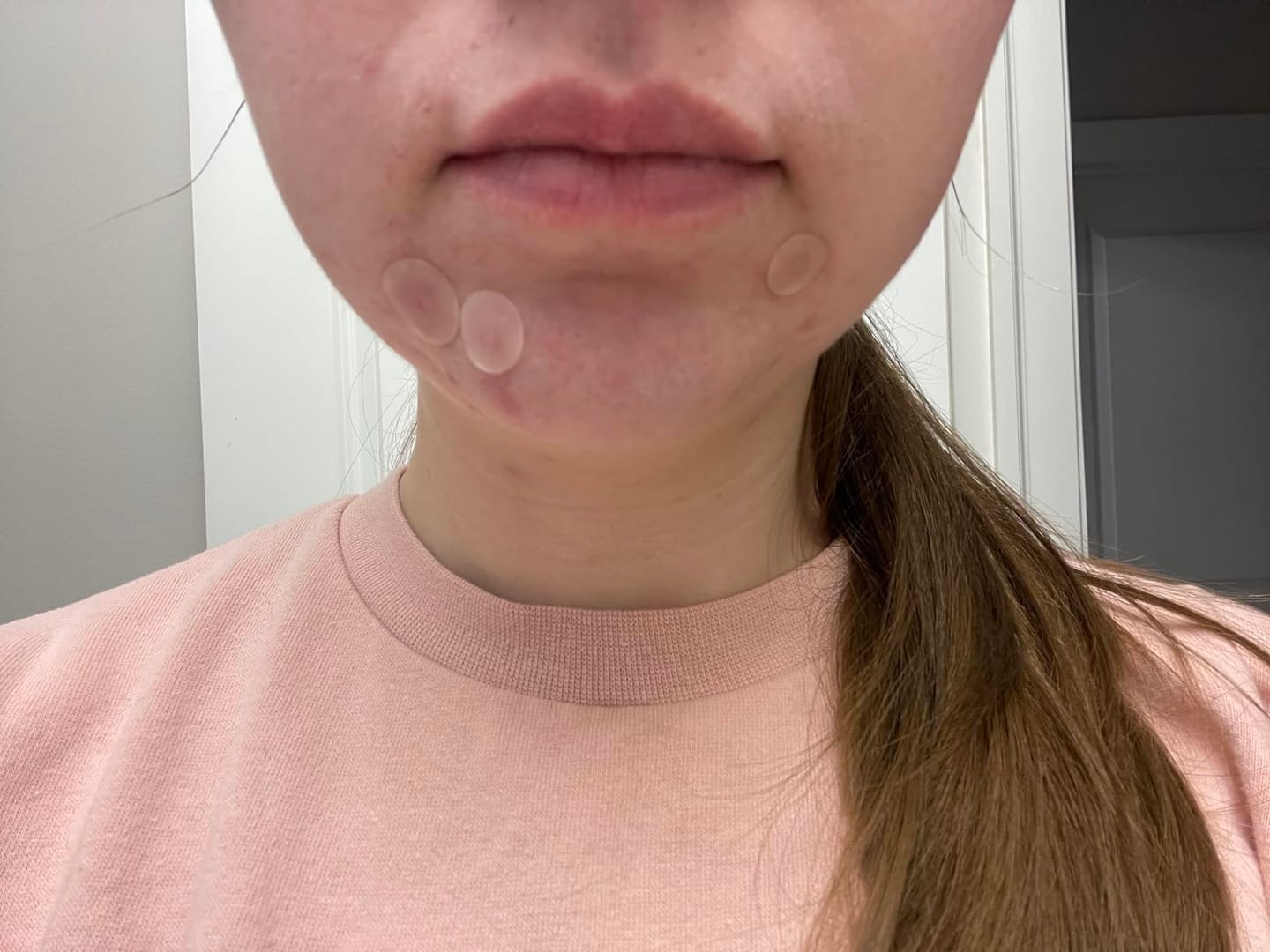 Customer photo review of 272 CT Pimple Patches Variety Pack w/ Tea Tree Oil, Salicylic Acid & Calendula Oil