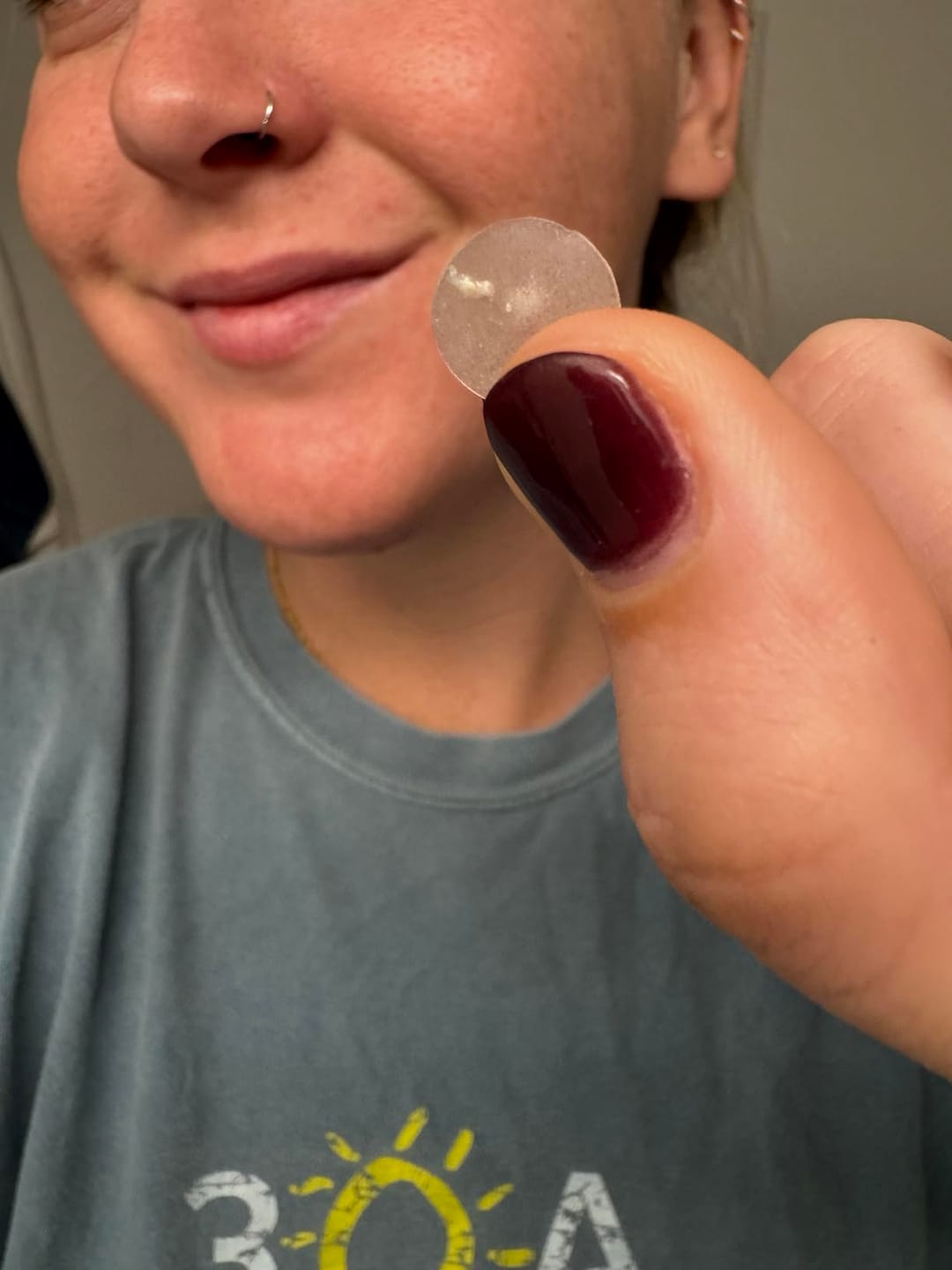 Customer photo review of 272 CT Pimple Patches Variety Pack w/ Tea Tree Oil, Salicylic Acid & Calendula Oil