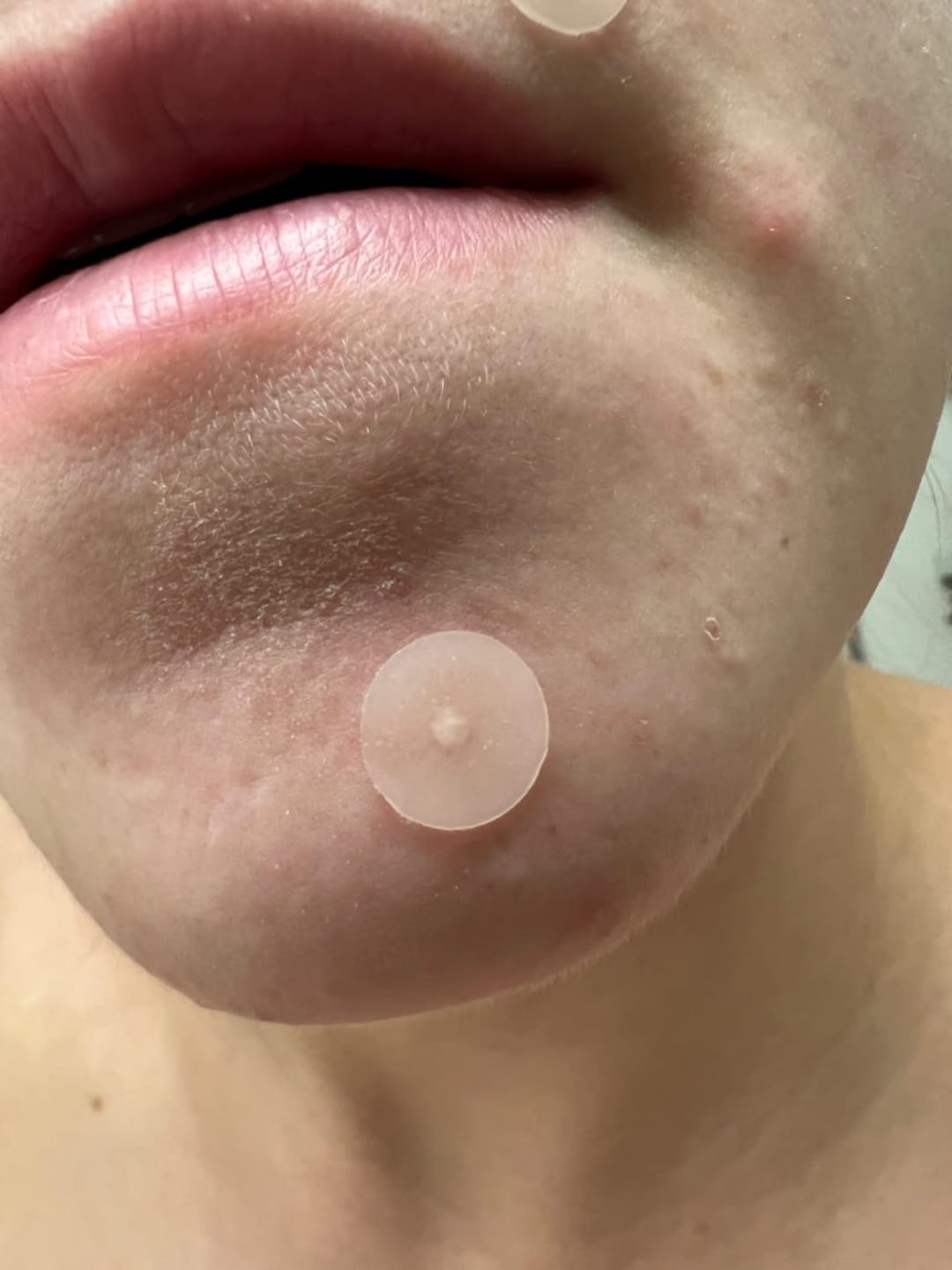 Customer photo review of 272 CT Pimple Patches Variety Pack w/ Tea Tree Oil, Salicylic Acid & Calendula Oil