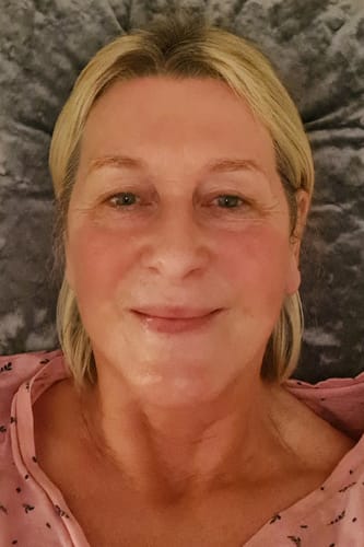 Customer photo review of Scar Minimising Oil