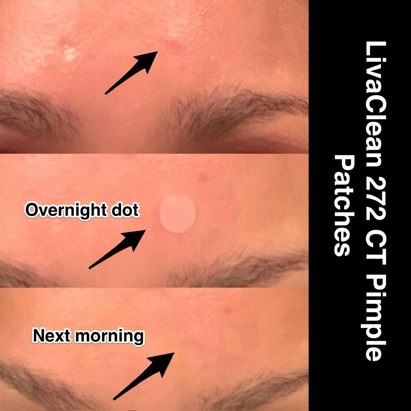 Customer photo review of 272 CT Pimple Patches Variety Pack w/ Tea Tree Oil, Salicylic Acid & Calendula Oil