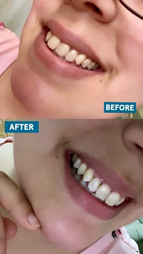 Customer photo review of Whitening Strips (7-day treatment)