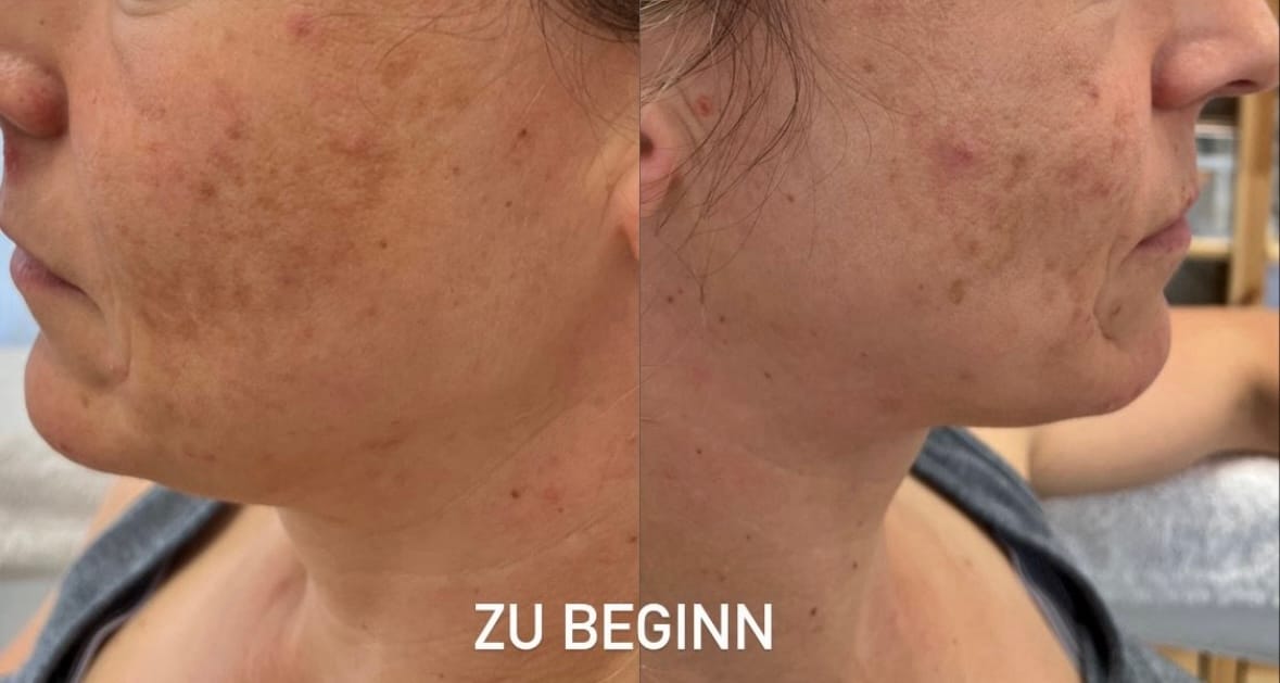 Customer photo review of SQT Biomicroneedling Testset inkl. Online Schulung