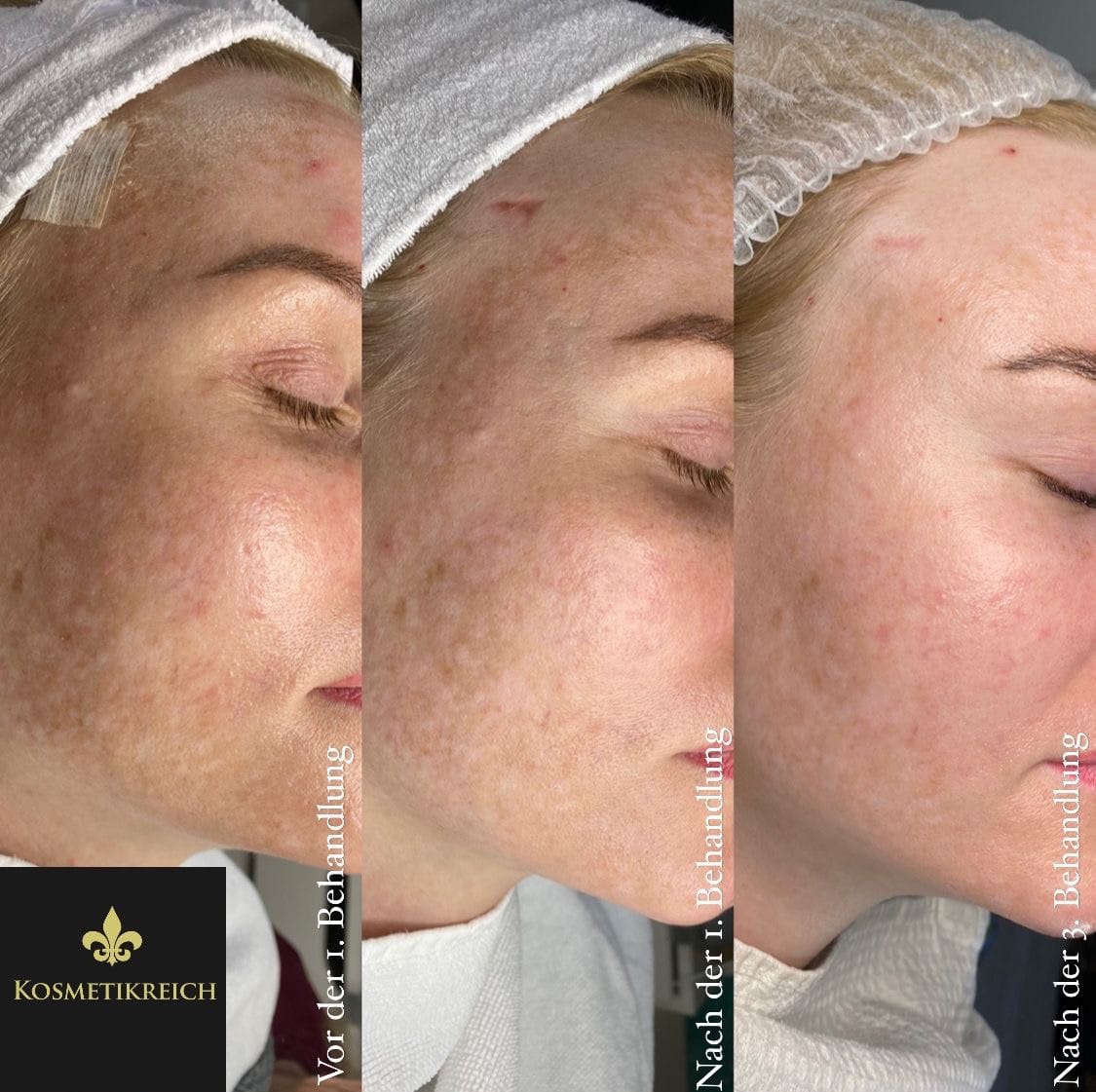 Customer photo review of SQT Biomicroneedling großes Starterset inkl. Online Schulung