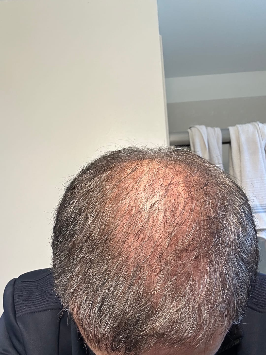 Customer photo review of Biotin Hair Restoration Spray, Follicle Stimulator & DHT Blocker