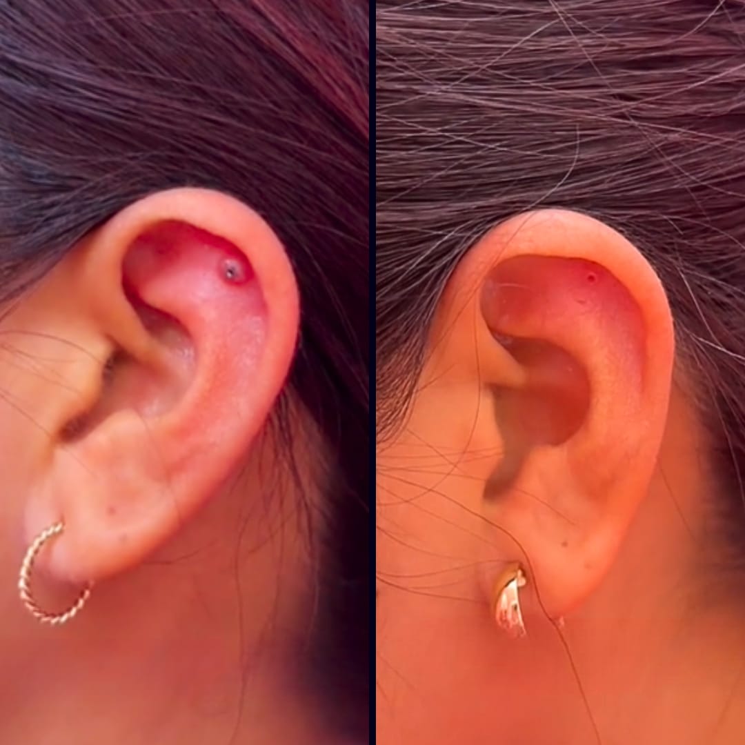 Customer photo review of Piercing Aftercare Hypochlorous Acid Spray