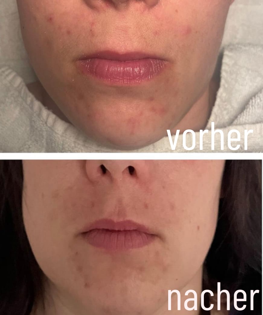 Customer photo review of SQT Biomicroneedling Testset inkl. Online Schulung