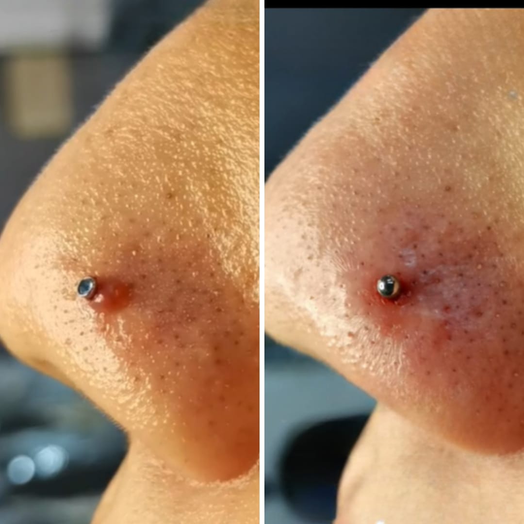 Customer photo review of Piercing Aftercare Hypochlorous Acid Spray
