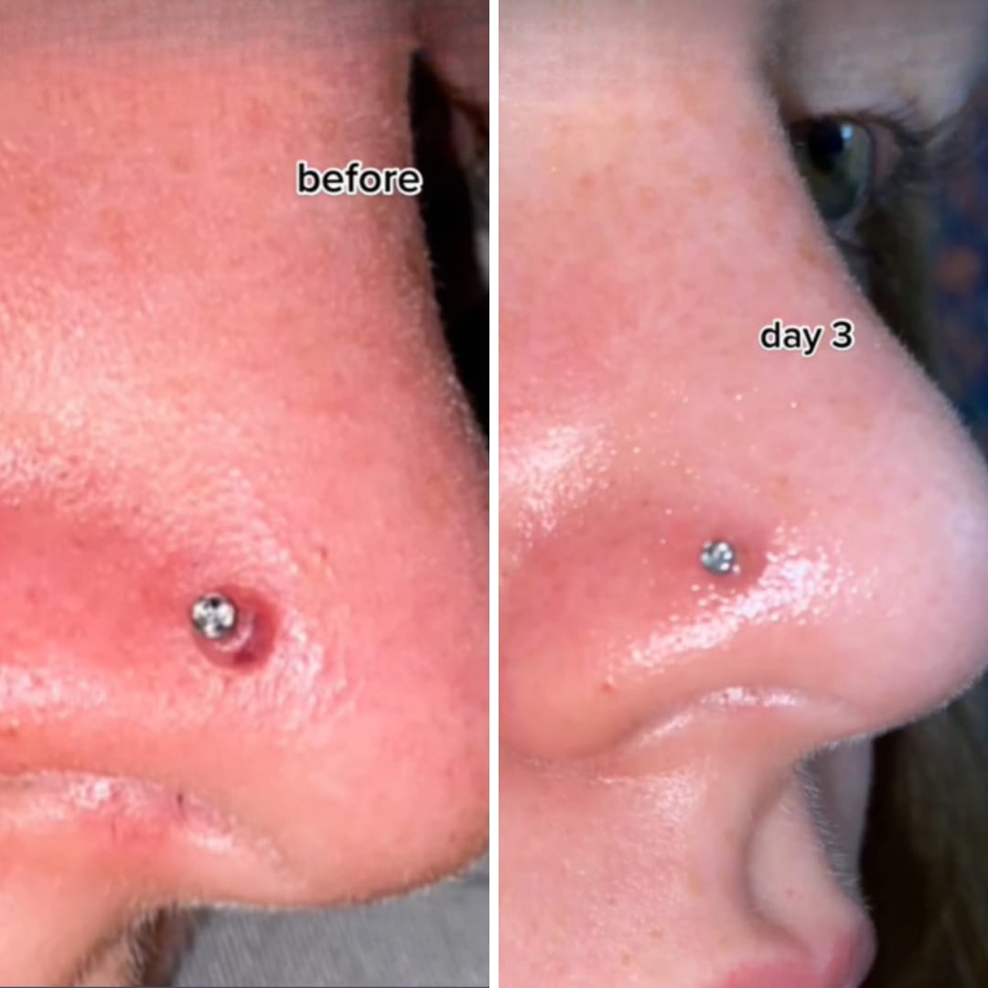 Customer photo review of Piercing Aftercare Hypochlorous Acid Spray