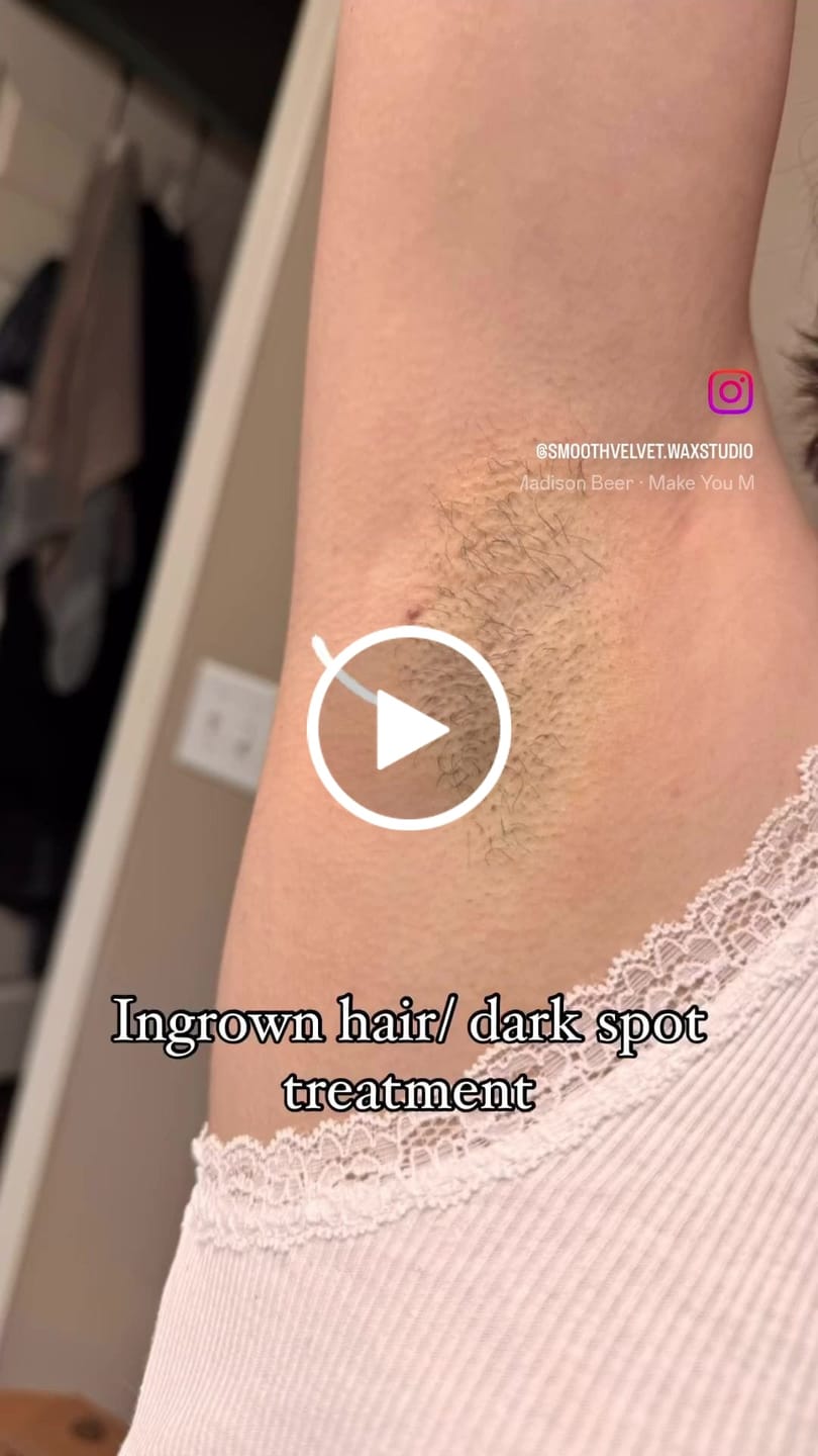 Customer video review of Smooth Operator Ingrown Hair Serum (Roll on & Pad Formula)
