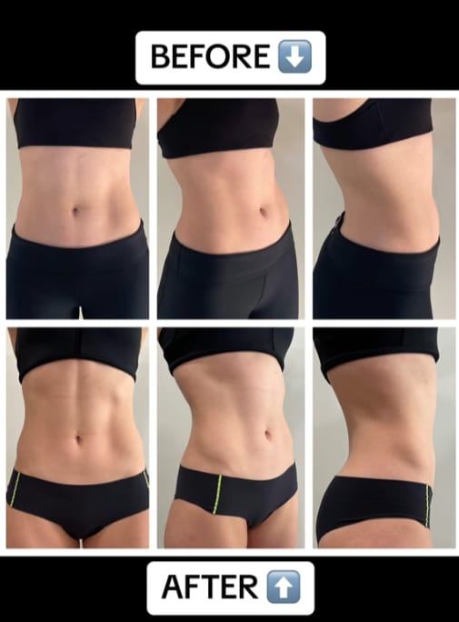 Customer photo review of EMSlim Neo Machine with RF Plus