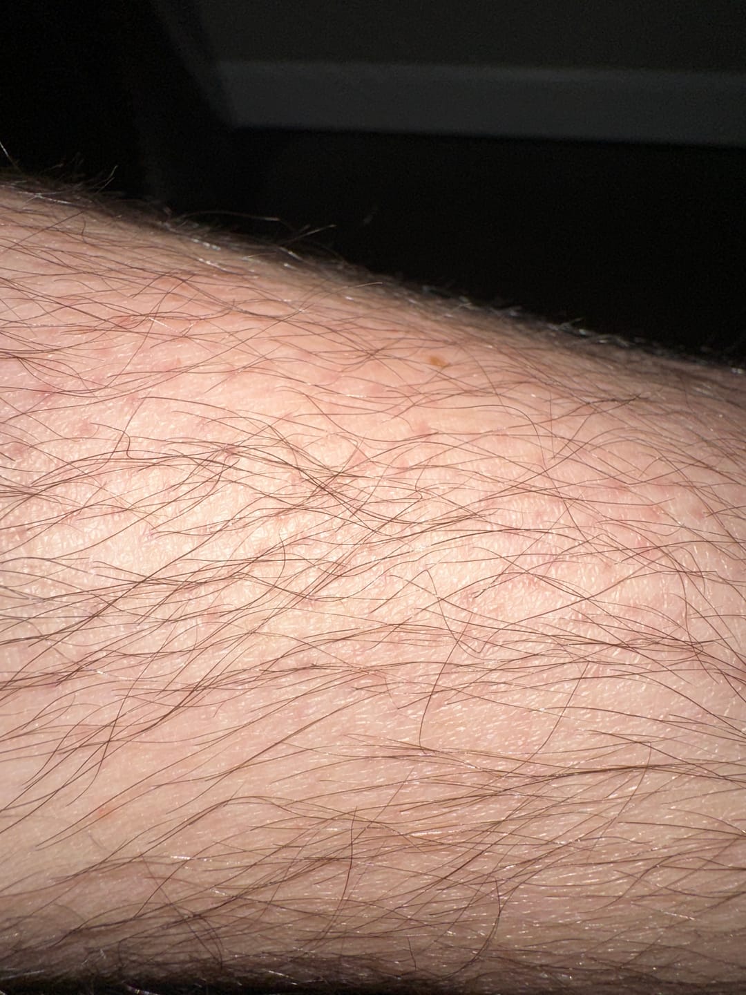 Customer photo review of Psoriasis Honey Nourishing Scalp and Skin Serum