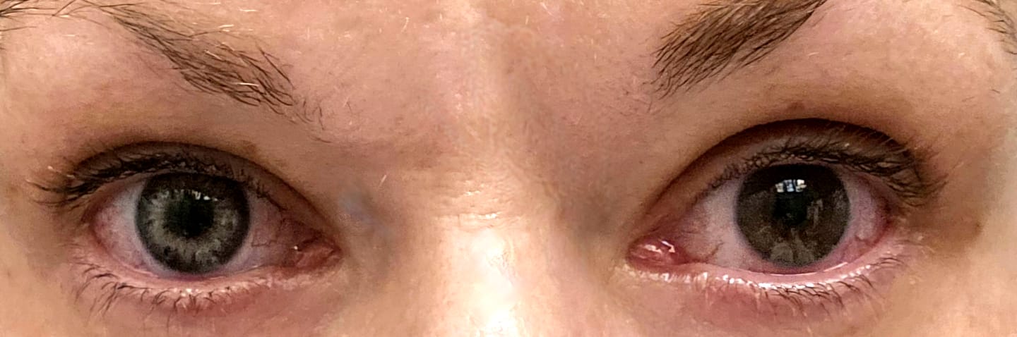 Customer photo review of DNA Taylor Pink Vitoel Coloured Contact Lenses