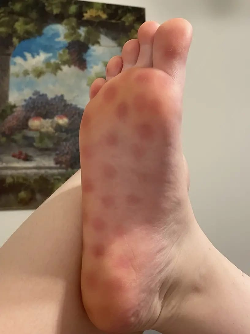 Customer photo review of Acupressure Sandals