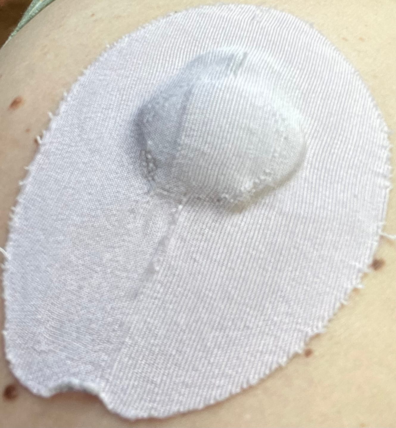 Customer photo review of Skin Grip Original - Medtronic Guardian/Enlite Adhesive Patches - 20 Pack