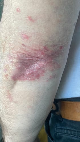 Customer photo review of Psoralyn - pikkelysömör elleni krém