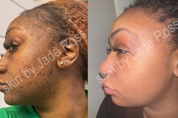 Customer photo review of Vitamin C Serum  (25% )